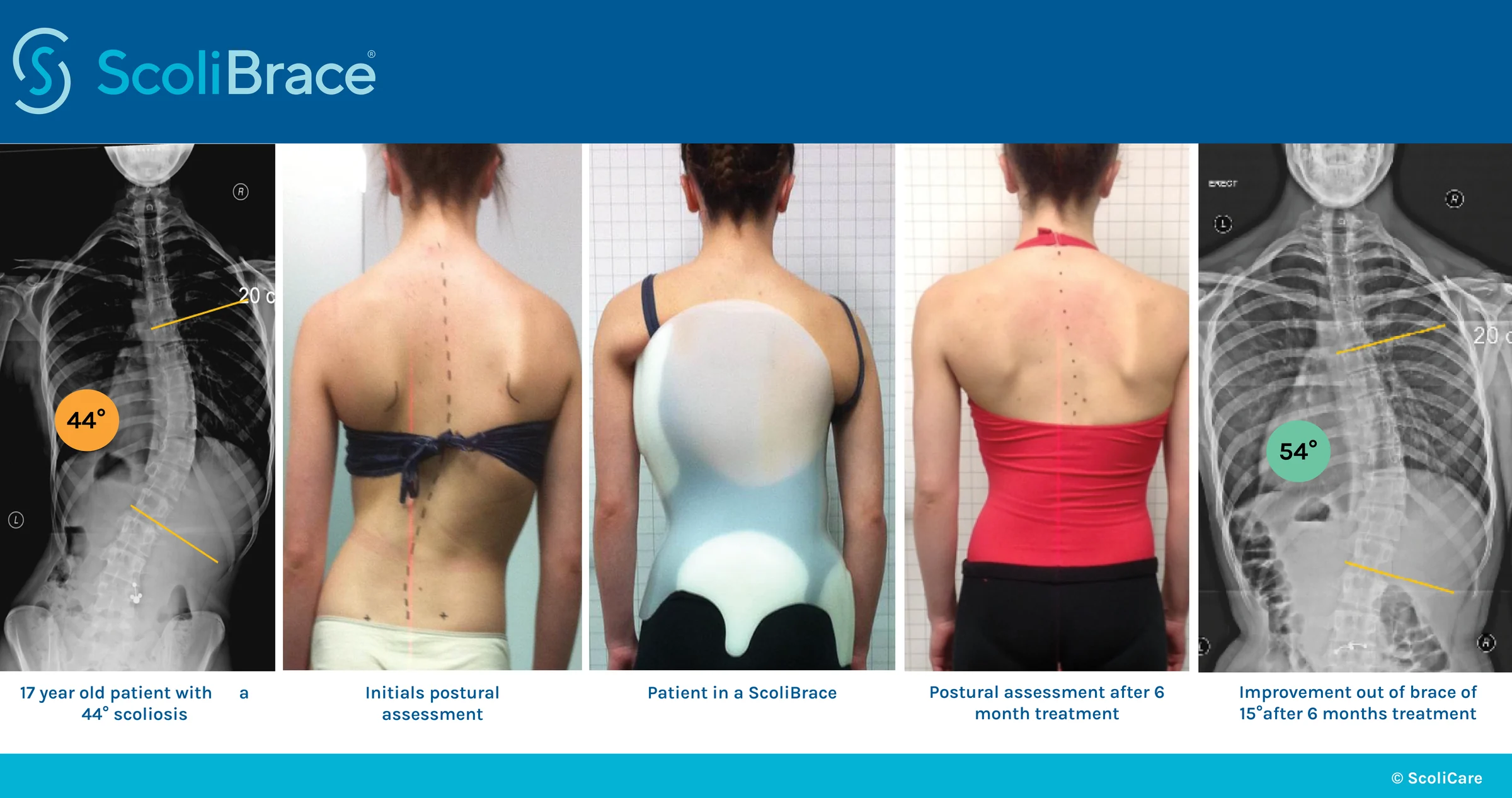 ScoliBrace case study: a 17 year old patient with a 44 degree scoliosis, her initial postural assessment, the same patient wearing a ScoliBrace, her postural assessment after six months, and the improvement measured out of the brace