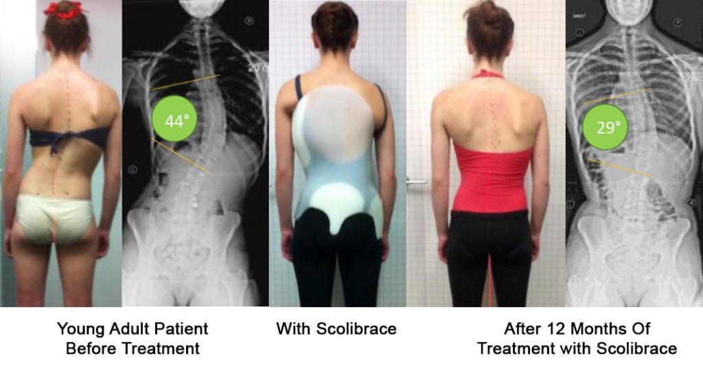Scoliosis Treatment and Options Spine and Scoliosis Clinic